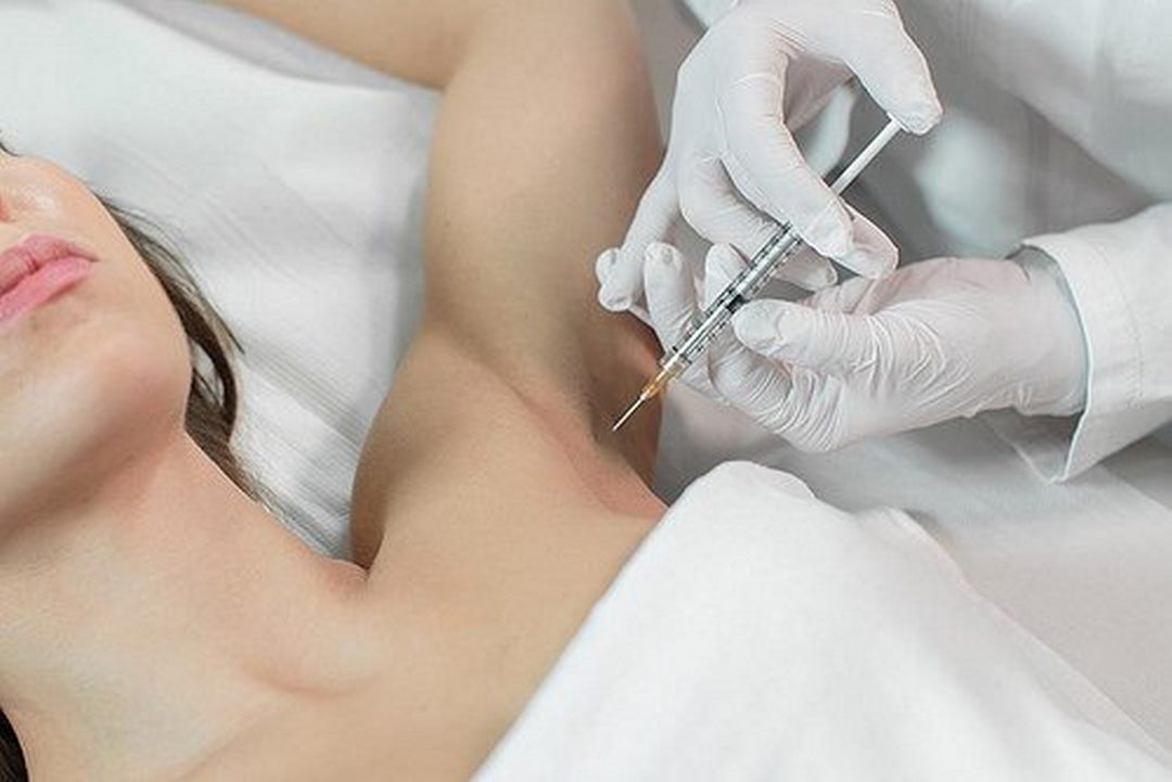 Botox chữa tăng tiết mồ hôi bằng cách nào?