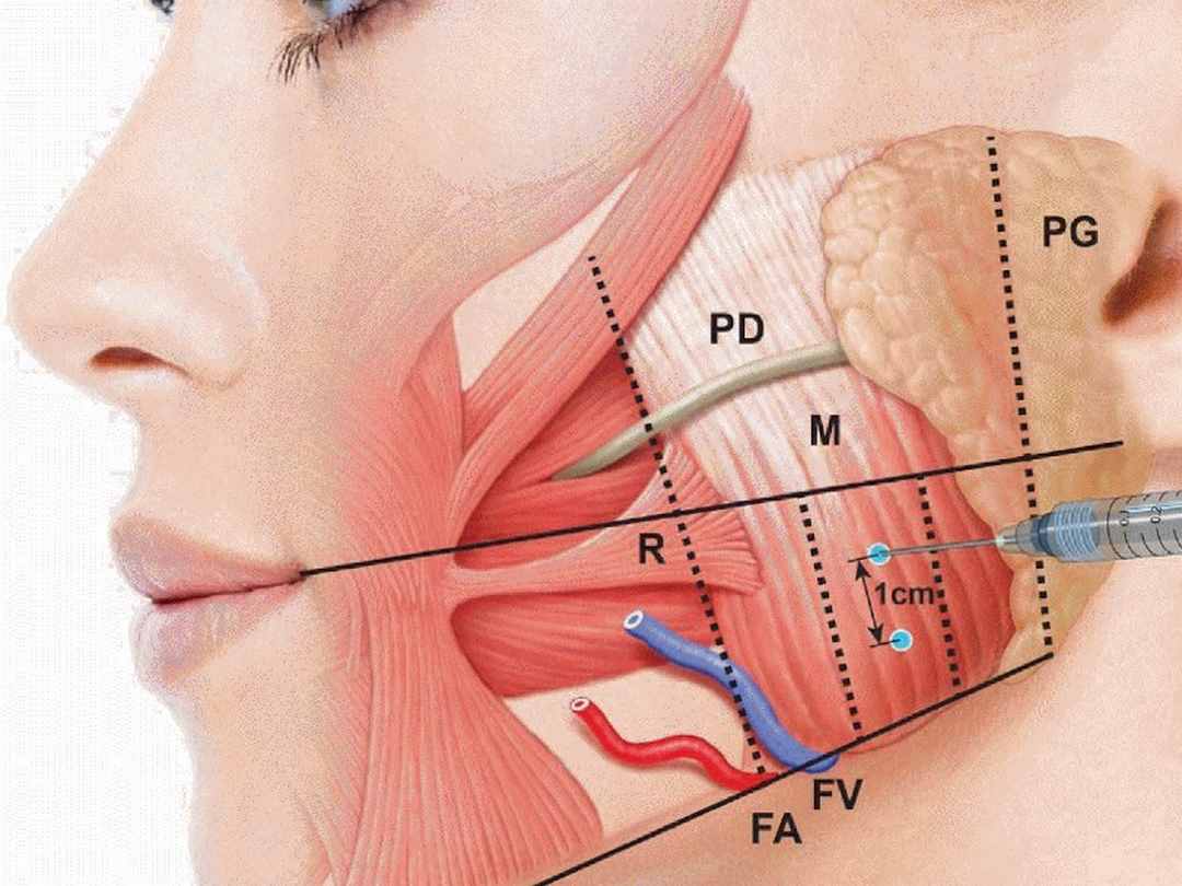 Tác dụng của tiêm botox thon gọn hàm